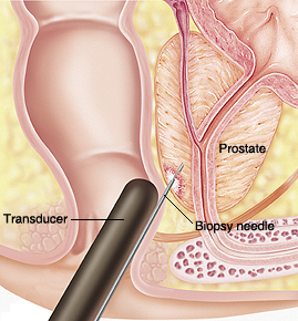 biopsia prostática