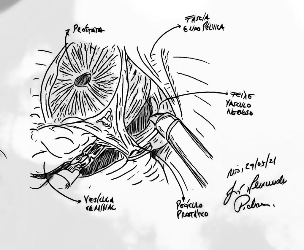 cirurgia robótica de próstata
